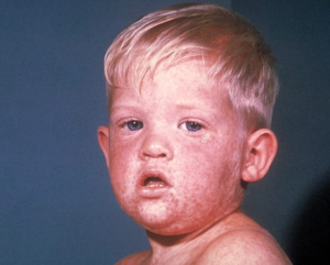 Boy's Face with Measles